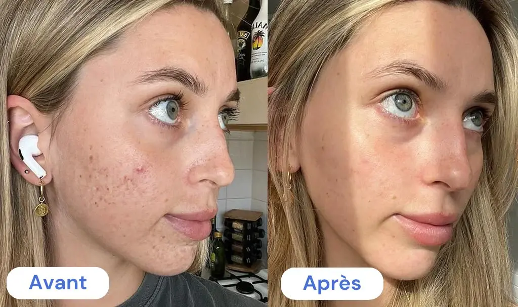 Cure collagène avant après, résultats et avis